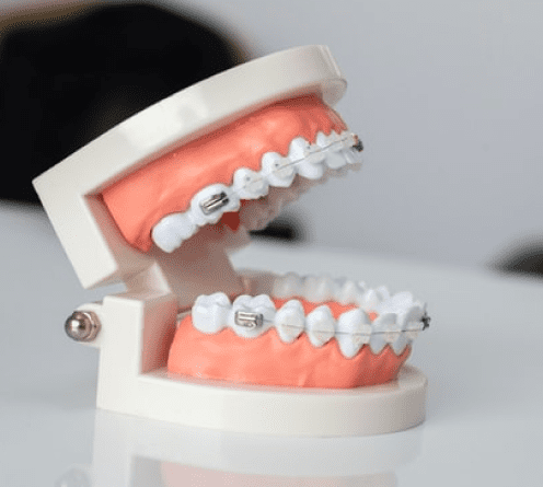 Исправление прикуса (временно отсутствует)