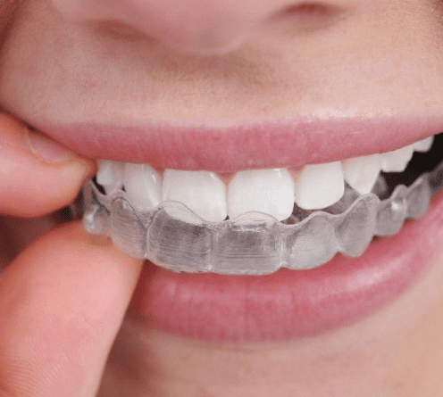 Элайнеры для выравнивания зубов (временно отсутствует)