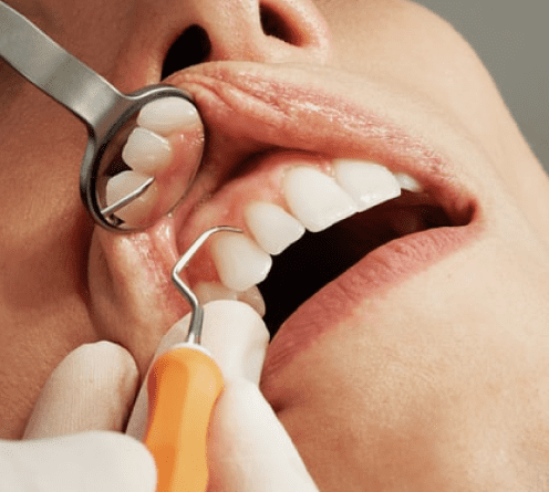 Лечение кариеса