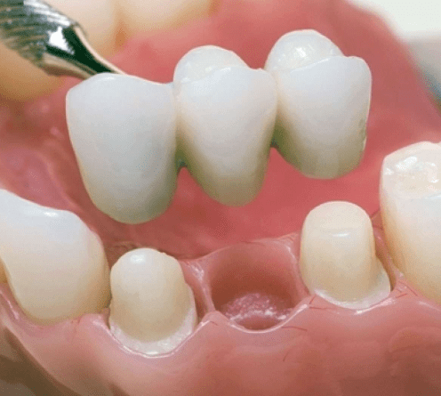 Мостовидные зубные протезы