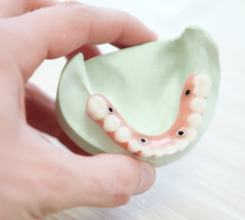 Имплантация зубов All-on-4