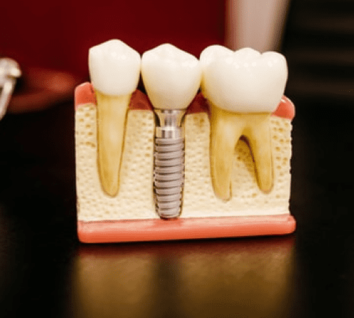 Коронки металлокерамические