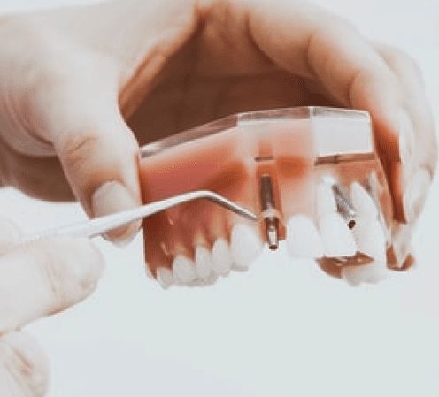 Протезирование с помощью корней зуба