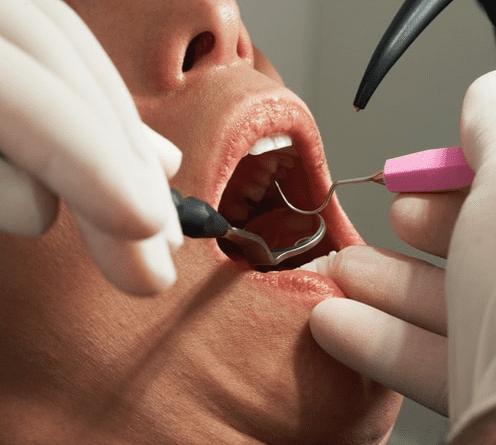 Пломбирование зуба