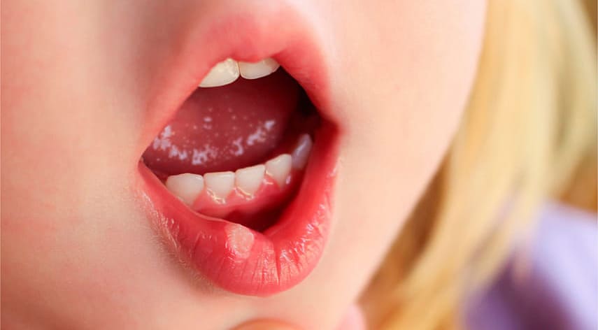 Профилактика развития заболеваний полости рта у детей