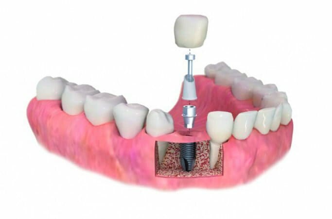 Протезирование с помощью корней зуба